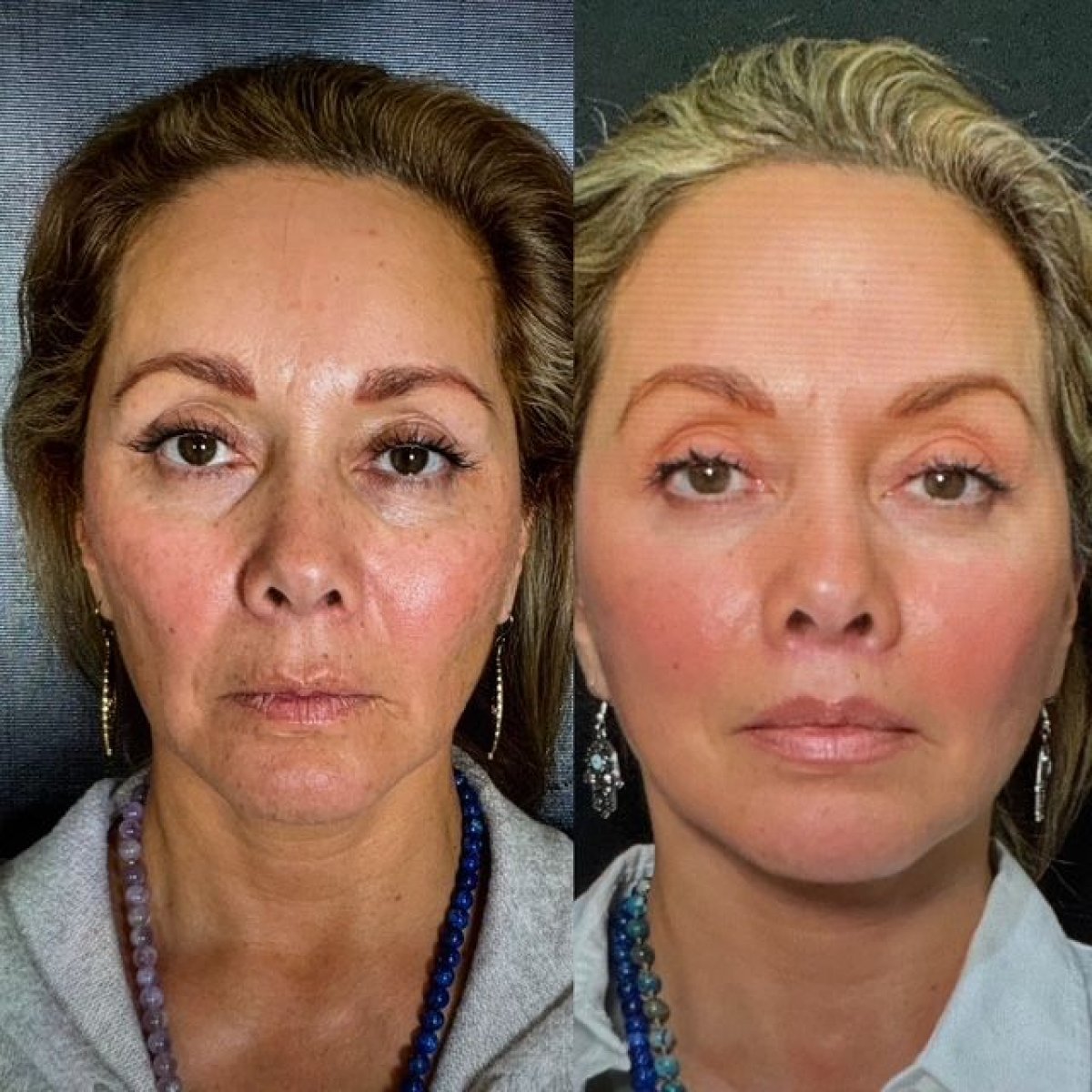 Blepharoplasty + Deep Plane Lifting Before & After