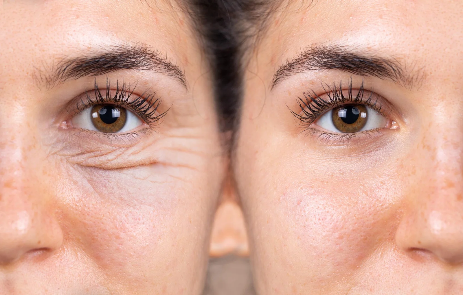 Blepharoplasty Before & After